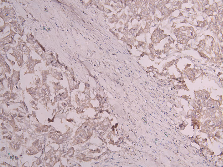 IHC image diluted at 1:300 and staining in paraffin-embedded human breast cancer performed on a Leica BondTM system. After dewaxing and hydration, antigen retrieval was mediated by high pressure in a citrate buffer (pH 6.0). Section was blocked with 10% normal goat serum 30min at RT. Then primary antibody (1% BSA) was incubated at 4Â°C overnight. The primary is detected by a Goat anti-human polymer IgG labeled by HRP and visualized using 0.05% DAB.