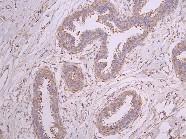 IHC image diluted at 1:200 and staining in paraffin-embedded human breast cancer performed on a Leica BondTM system. After dewaxing and hydration, antigen retrieval was mediated by high pressure in a citrate buffer (pH 6.0). Section was blocked with 10% normal goat serum 30min at RT. Then primary antibody (1% BSA) was incubated at 4Â°C overnight. The primary is detected by a Goat anti-human polymer IgG labeled by HRP and visualized using 0.05% DAB.