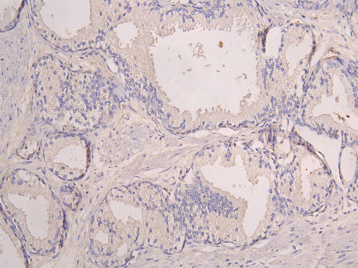 IHC image diluted at 1:100 and staining in paraffin-embedded human prostate cancer performed on a Leica BondTM system. After dewaxing and hydration, antigen retrieval was mediated by high pressure in a citrate buffer (pH 6.0). Section was blocked with 10% normal goat serum 30min at RT. Then primary antibody (1% BSA) was incubated at 4Â°C overnight. The primary is detected by a Goat anti-human polymer IgG labeled by HRP and visualized using 0.05% DAB.