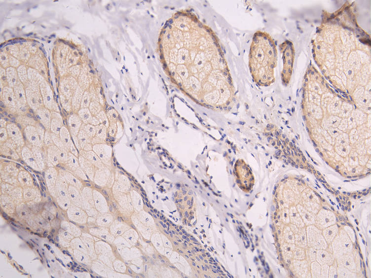 IHC image diluted at 1:100 and staining in paraffin-embedded human skin tissue performed on a Leica BondTM system. After dewaxing and hydration, antigen retrieval was mediated by high pressure in a citrate buffer (pH 6.0). Section was blocked with 10% normal goat serum 30min at RT. Then primary antibody (1% BSA) was incubated at 4Â°C overnight. The primary is detected by a Goat anti-human polymer IgG labeled by HRP and visualized using 0.05% DAB.