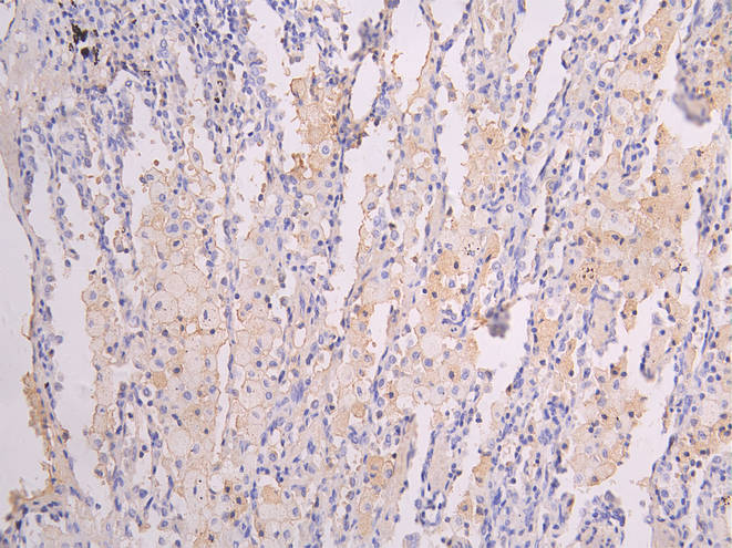 IHC image diluted at 1:200 and staining in paraffin-embedded human lung tissue performed on a Leica BondTM system. After dewaxing and hydration, antigen retrieval was mediated by high pressure in a citrate buffer (pH 6.0). Section was blocked with 10% normal goat serum 30min at RT. Then primary antibody (1% BSA) was incubated at 4Â°C overnight. The primary is detected by a Goat anti-human polymer IgG labeled by HRP and visualized using 0.05% DAB.