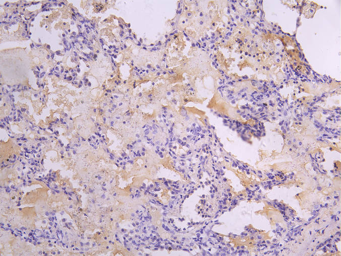IHC image diluted at 1:100 and staining in paraffin-embedded performed on a Leica BondTM system. After dewaxing and hydration, antigen retrieval was mediated by high pressure in a citrate buffer (pH 6.0). Section was blocked with 10% normal goat serum 30min at RT. Then primary antibody (1% BSA) was incubated at 4Â°C overnight. The primary is detected by a Goat anti-human polymer IgG labeled by HRP and visualized using 0.05% DAB.