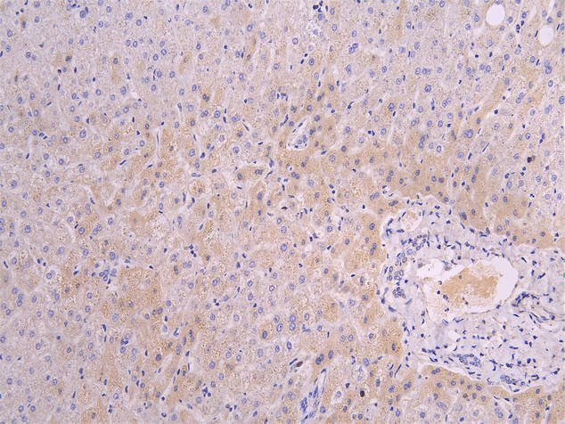 IHC image diluted at 1:100 and staining in paraffin-embedded human liver tissue performed on a Leica BondTM system. After dewaxing and hydration, antigen retrieval was mediated by high pressure in a citrate buffer (pH 6.0). Section was blocked with 10% normal goat serum 30min at RT. Then primary antibody (1% BSA) was incubated at 4Â°C overnight. The primary is detected by a Goat anti-human polymer IgG labeled by HRP and visualized using 0.05% DAB.