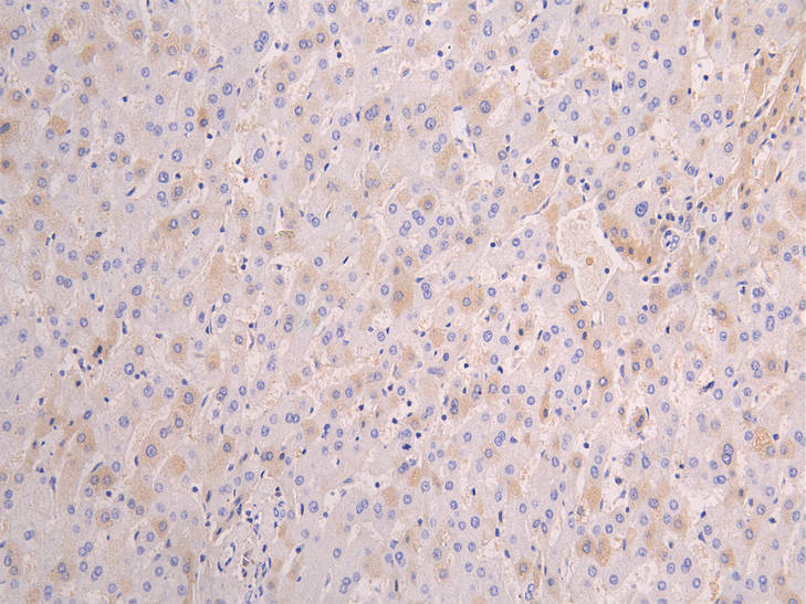 IHC image diluted at 1:100 and staining in paraffin-embedded human liver tissue performed on a Leica BondTM system. After dewaxing and hydration, antigen retrieval was mediated by high pressure in a citrate buffer (pH 6.0). Section was blocked with 10% normal goat serum 30min at RT. Then primary antibody (1% BSA) was incubated at 4Â°C overnight. The primary is detected by a Goat anti-human polymer IgG labeled by HRP and visualized using 0.05% DAB.