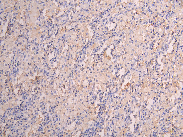 IHC image diluted at 1:150 and staining in paraffin-embedded human lung tissue performed on a Leica BondTM system. After dewaxing and hydration, antigen retrieval was mediated by high pressure in a citrate buffer (pH 6.0). Section was blocked with 10% normal goat serum 30min at RT. Then primary antibody (1% BSA) was incubated at 4Â°C overnight. The primary is detected by a Goat anti-human polymer IgG labeled by HRP and visualized using 0.05% DAB.